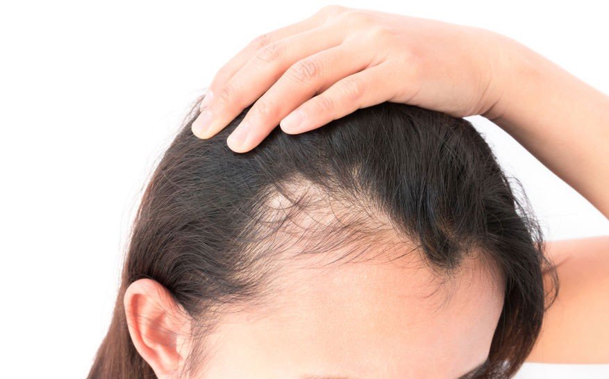 Hair Loss Solutions At Dudley's Hairdressers In Bulwell