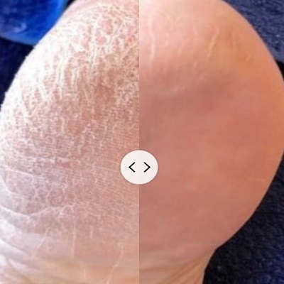 LOVA SKIN PEELS AT DUDLEYS BEAUTY SALON IN BULWELL NOTTINGHAM LOVA SKIN PEELS AT DUDLEYS BEAUTY SALON IN BULWELL NOTTINGHAM